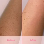 IPL Laser Hair Removal Handset - Image 4